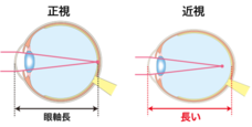 近視の目の状態